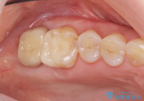 歯髄方向　歯肉方向へと深い 2種類の大きな虫歯の治療後