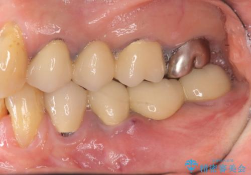 ブリッジ支台の歯の痛み　インプラントによる咬合負担の治療前