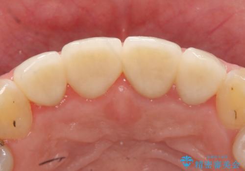 オールセラミッククラウン　前歯を綺麗に　神経が死んだ歯の再治療～補綴の治療後