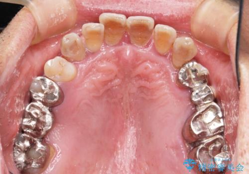 [歯周病治療]  歯周補綴　インプラント補綴の治療前