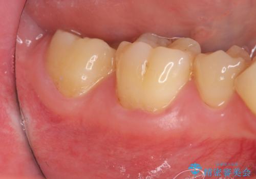 歯ぐきが下がり歯がしみる　歯肉移植による治療の治療前