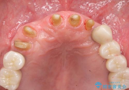 [歯周病治療]  歯周補綴　インプラント補綴の治療中
