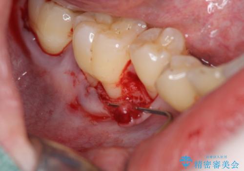 歯ぐきが下がり歯がしみる　歯肉移植による治療の治療中