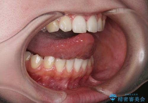 [舌小帯形成術]   ベロが短く話しづらいの症例 治療前