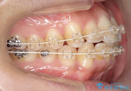 歯を抜かない矯正　奥歯のすれ違い咬合　下の八重歯　の治療中