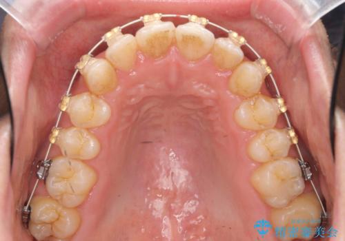 歯を抜かない矯正　奥歯のすれ違い咬合　下の八重歯　の治療中