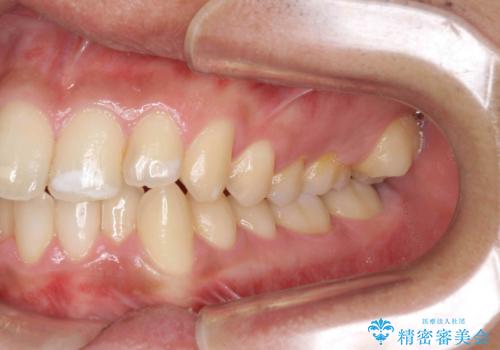 歯を抜かない矯正　奥歯のすれ違い咬合　下の八重歯　の治療前