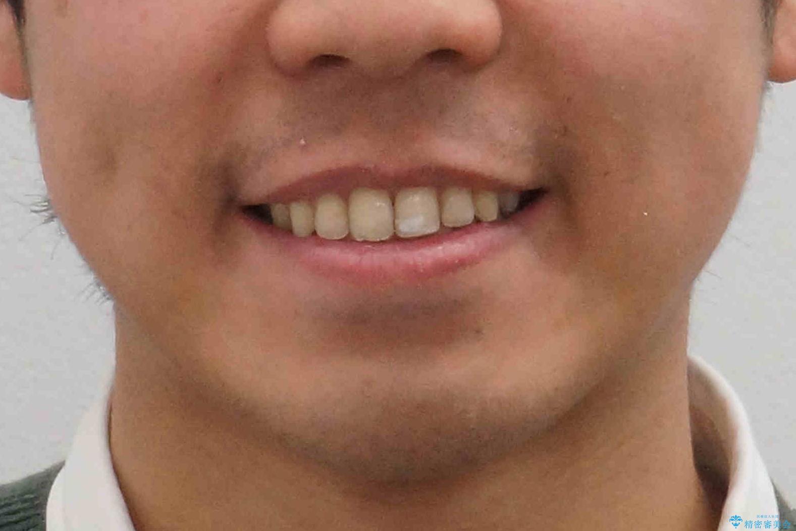 歯を抜かない矯正　奥歯のすれ違い咬合　下の八重歯　の治療後（顔貌）