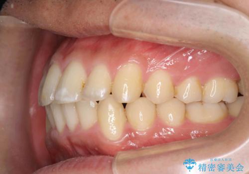 歯を抜かない矯正　奥歯のすれ違い咬合　下の八重歯　の治療後