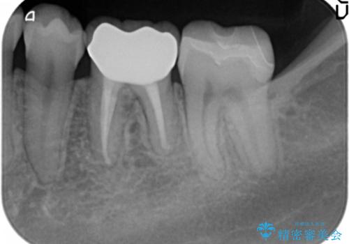 セラミックインレー　下の一番奥歯　歯ぐきの厚みを減らしてぴったりに入れます(ディスタルウェッジ+骨外科)の治療後
