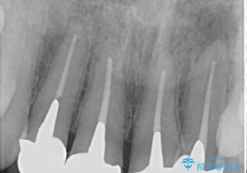 前歯のオールセラミック　腫れている歯肉が改善の治療前
