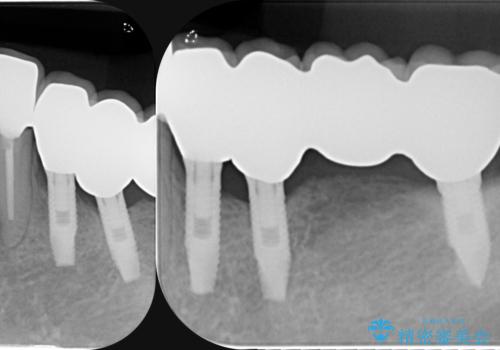 虫歯による歯の喪失　インプラントによる咬合機能回復の治療後