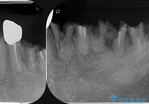 虫歯による歯の喪失　インプラントによる咬合機能回復の治療前