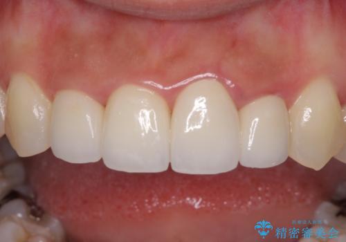 前歯のオールセラミック　腫れている歯肉が改善の治療後