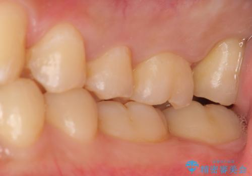 歯を抜かない矯正　奥歯のすれ違い咬合　下の八重歯　の治療後