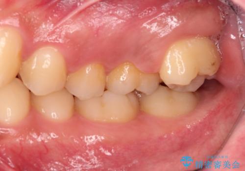歯を抜かない矯正　奥歯のすれ違い咬合　下の八重歯　の治療前