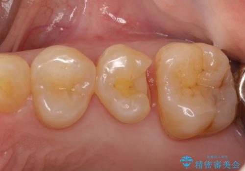 虫歯の治療。ゴールドインレーによる治療の治療中