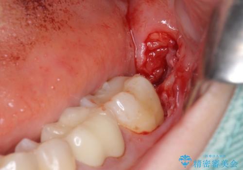 セラミックインレー　下の一番奥歯　歯ぐきの厚みを減らしてぴったりに入れます(ディスタルウェッジ+骨外科)の治療中