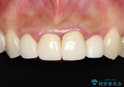 前歯のオールセラミック　腫れている歯肉が改善の治療前
