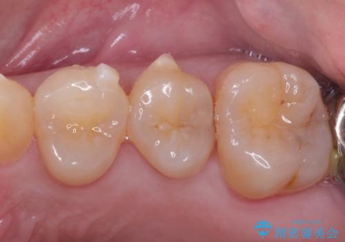 虫歯の治療。ゴールドインレーによる治療の治療前