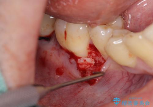 歯ぐきが下がり歯がしみる　歯肉移植による治療の治療中