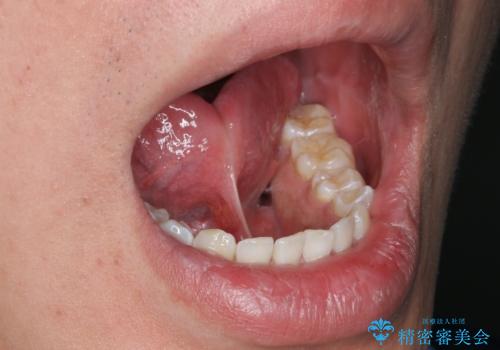[滑舌が気になる] 舌小帯形成術の症例 治療前