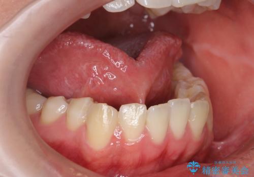 舌が持ち上がらない　舌小帯切除の症例 治療前