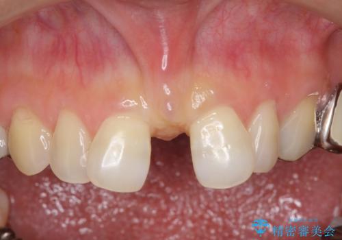 大人の上唇小帯切除　前歯のすき間の原因になりますの症例 治療前