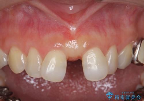 大人の上唇小帯切除　前歯のすき間の原因になりますの症例 治療後