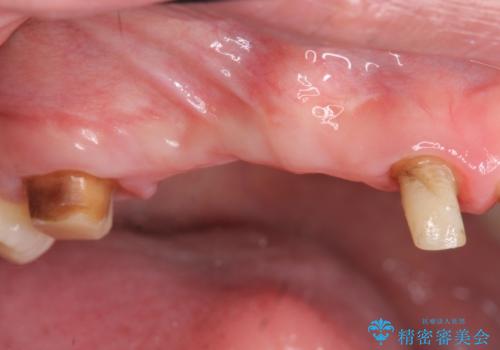 虫歯による多数歯欠損　インプラント咬合機能回復の症例 治療前
