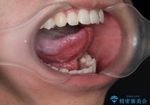 [滑舌が気になる] 舌小帯形成術の症例 治療後