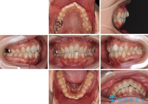 インビザラインによる狭窄歯列の拡大矯正　の治療前