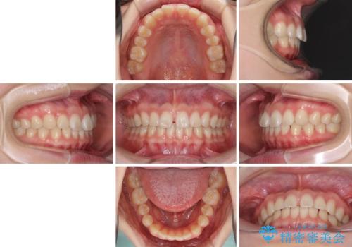 インビザラインによるすきっ歯の改善の治療前