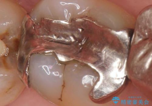[銀歯の下の虫歯 ] 根管治療を伴う虫歯治療の治療前