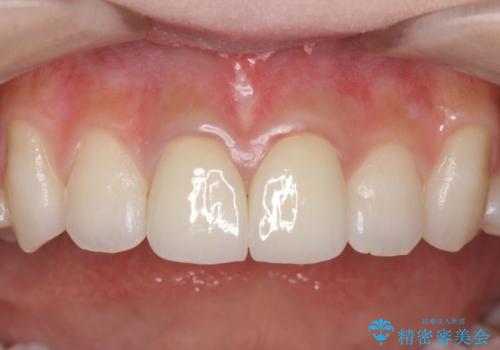 前歯の変色　セラミックで　ホワイトニングも併用の治療後