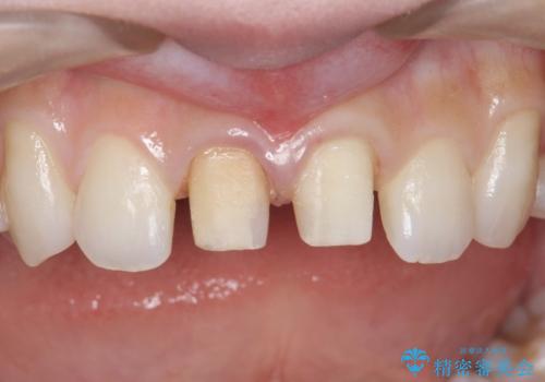 前歯の変色　セラミックで　ホワイトニングも併用の治療中