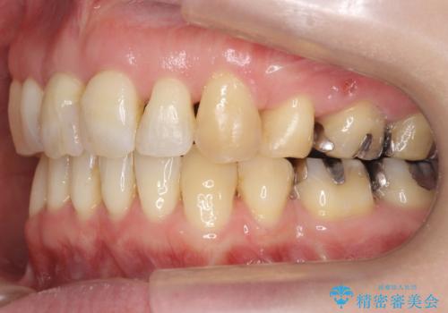 40代の矯正　出っ歯、歯のがたがたの治療後