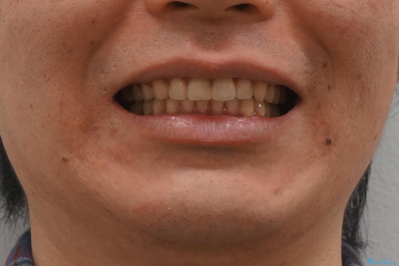 前歯のねじれを　1年かけずに矯正　インビザラインの治療後（顔貌）