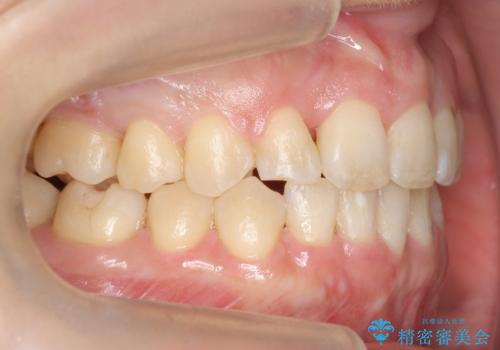 30代女性　残った乳歯を抜いてスペースを閉じる矯正　前歯のねじれの治療後