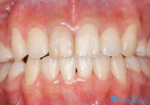 前歯の変色　セラミックで　ホワイトニングも併用の治療前