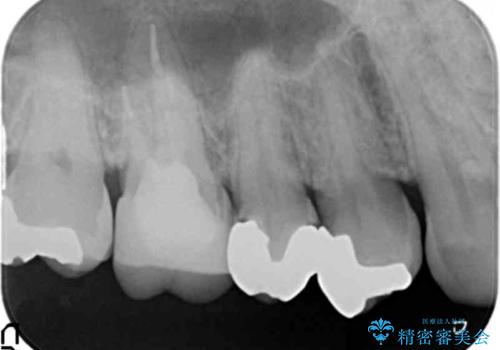 銀歯の下が虫歯　セラミックインレーにの治療前