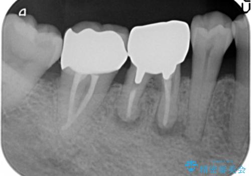 [銀歯の下の虫歯 ] 根管治療を伴う虫歯治療の治療後