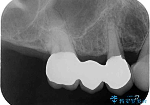 歯の欠損を放置　オールセラミックブリッジによる補綴治療の治療後