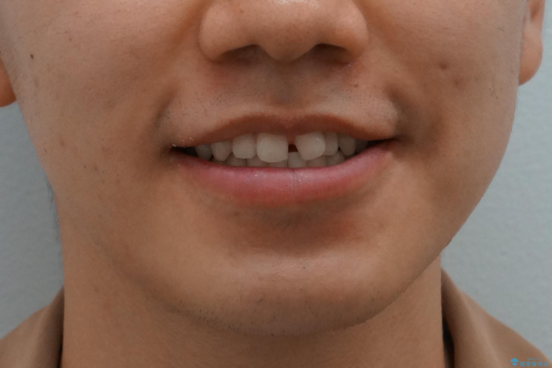 前歯のねじれ　上だけ部分矯正でコストダウンの治療前（顔貌）