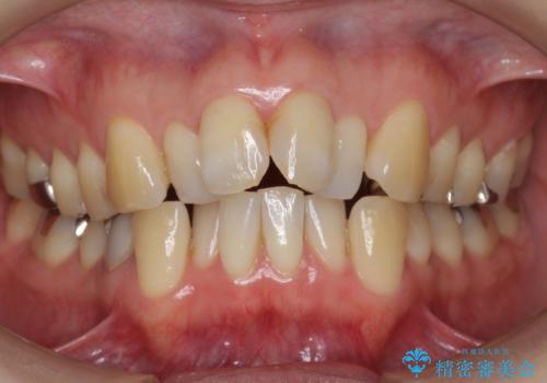 40代の矯正　出っ歯、歯のがたがたの治療前