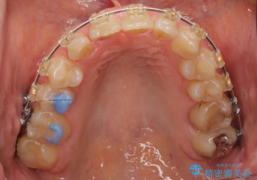 30代女性　残った乳歯を抜いてスペースを閉じる矯正　前歯のねじれの治療中
