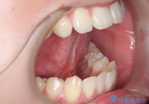 舌小帯切除　舌が動かしにくいの症例 治療後