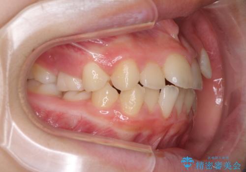 乳歯が残っている　目立たない装置での抜歯矯正の治療前