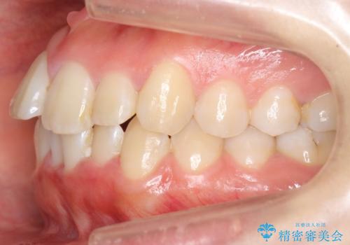 上下の前歯のがたつき　歯を抜かずに矯正の治療前