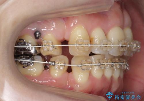 40代の矯正　出っ歯、歯のがたがたの治療中